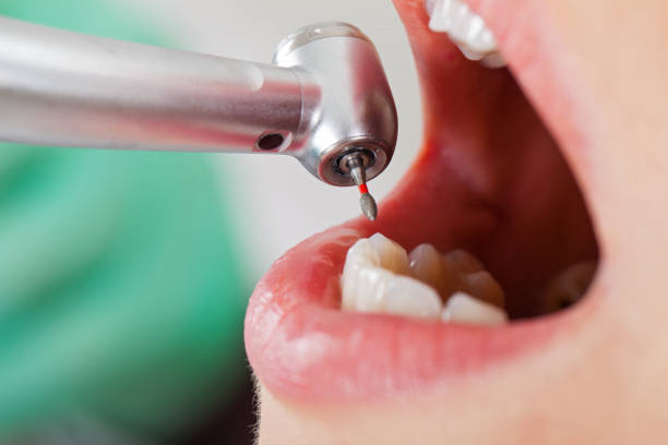 Teeth Whitening in MO